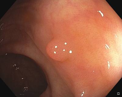 Sample image from Fine Grained Polyp