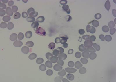 Sample image from P. Vivax (Malaria) Infected Human Blood Smears