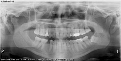 Sample image from Teeth Segmentation on Dental X-ray Images