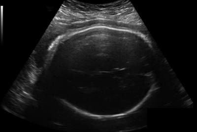 Sample image from Fetal Head UltraSound