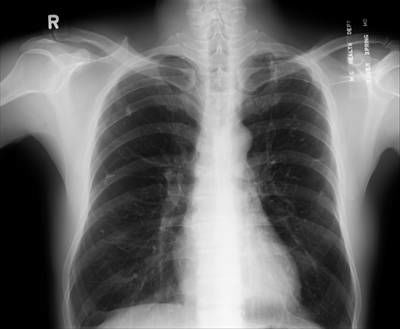 Sample image from Chest Xray Masks and Labels