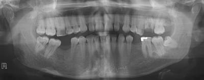 Sample image from Panoramic Dental X-rays