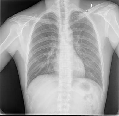 Sample image from Chest Xray Masks and Labels