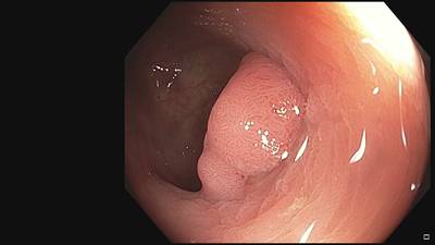 Sample image from Fine Grained Polyp