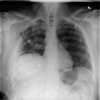 Sample image from SIIM-ACR Pneumothorax Segmentation 2019