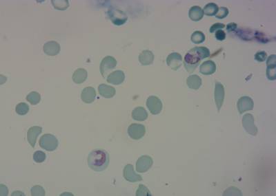 Sample image from P. Vivax (Malaria) Infected Human Blood Smears