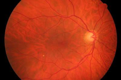 Sample image from High Resolution Fundus