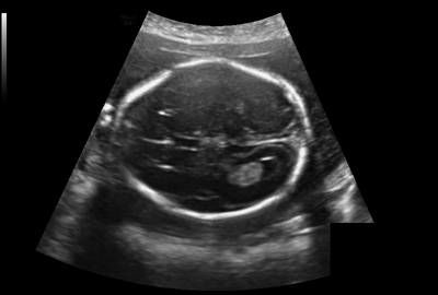 Sample image from Fetal Head UltraSound