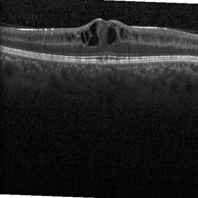 Sample image from Intraretinal Cystoid Fluid