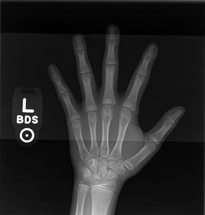 Sample image from RSNA Bone Age 2017