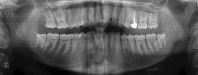 Sample image from Panoramic Dental X-rays