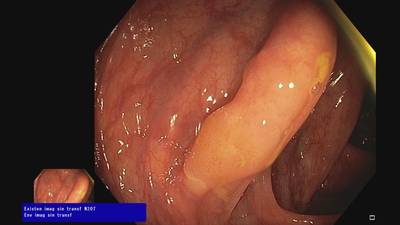 Sample image from Fine Grained Polyp