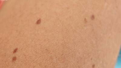 Sample image from Accurate Nevus Shapes