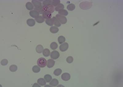 Sample image from P. Vivax (Malaria) Infected Human Blood Smears