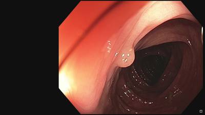 Sample image from Fine Grained Polyp