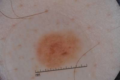 Sample image from ISIC 2017: Part 1 - Lesion Segmentation