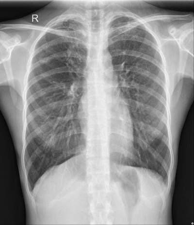 Sample image from Chest Xray Masks and Labels