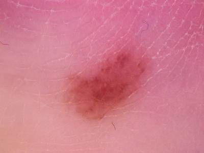 Sample image from Skin Cancer: HAM10000