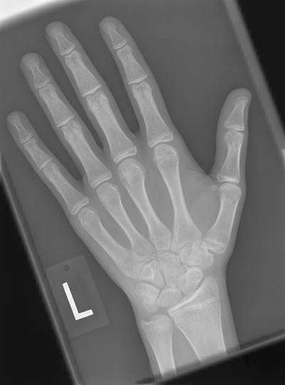 Sample image from RSNA Bone Age 2017