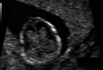 Sample image from Fetal Head UltraSound