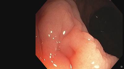 Sample image from Fine Grained Polyp