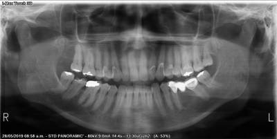 Sample image from Teeth Segmentation on Dental X-ray Images