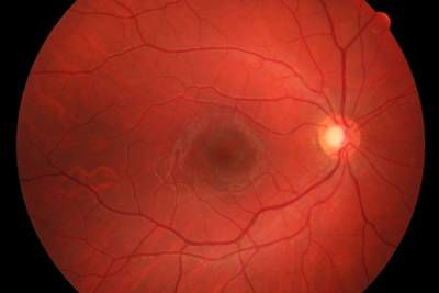 Sample image from High Resolution Fundus