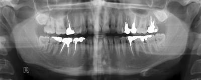 Sample image from Panoramic Dental X-rays