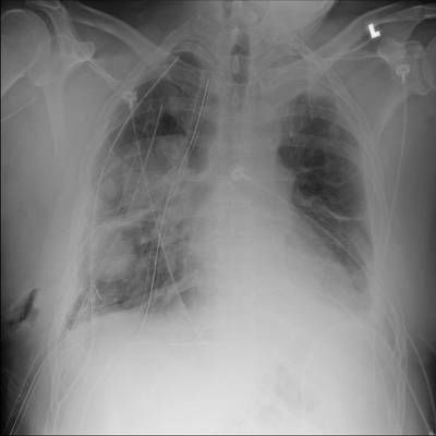 Sample image from SIIM-ACR Pneumothorax Segmentation 2019