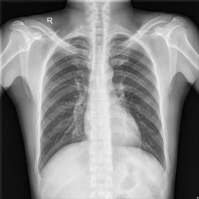 Sample image from Chest Xray Masks and Labels