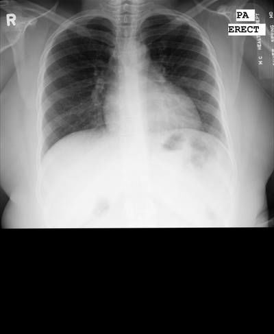 Sample image from Chest Xray Masks and Labels