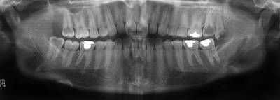 Sample image from Panoramic Dental X-rays