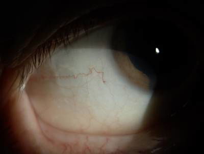 Sample image from Eyes Microcirculation