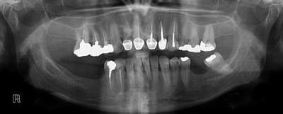 Sample image from Panoramic Dental X-rays