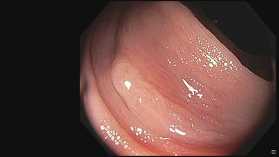 Sample image from Fine Grained Polyp