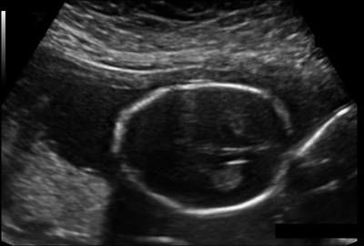 Sample image from Fetal Head UltraSound