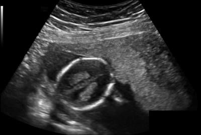 Sample image from Fetal Head UltraSound