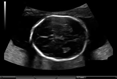 Sample image from Fetal Head UltraSound