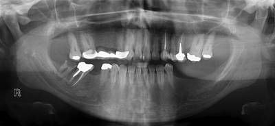 Sample image from Panoramic Dental X-rays