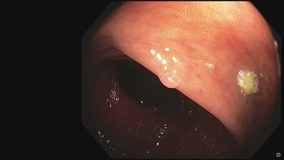 Sample image from Fine Grained Polyp