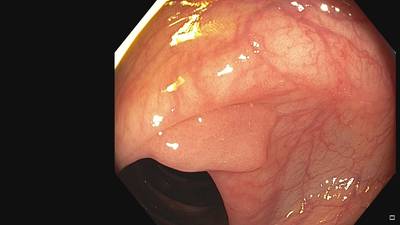 Sample image from Fine Grained Polyp