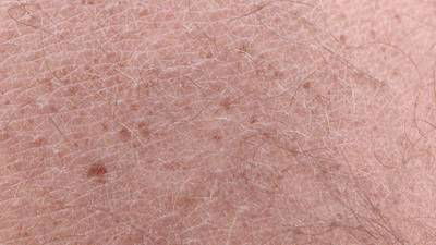 Sample image from Accurate Nevus Shapes