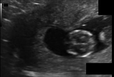 Sample image from Fetal Head UltraSound