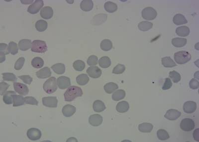 Sample image from P. Vivax (Malaria) Infected Human Blood Smears