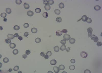 Sample image from P. Vivax (Malaria) Infected Human Blood Smears